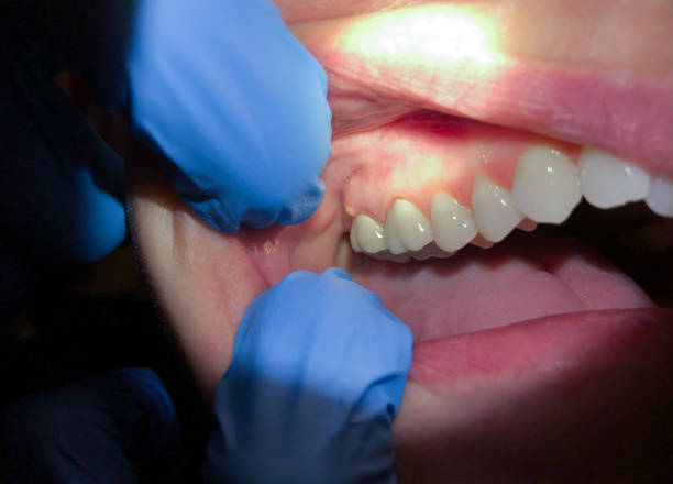 Best Emergency Denture Repair in Mahopac, NY